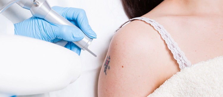 Laser Tattoo Removal
